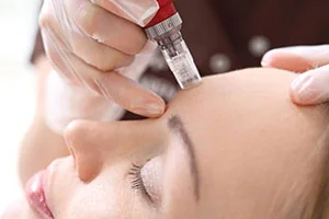 microneedling-2