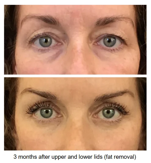 upper eyelid2