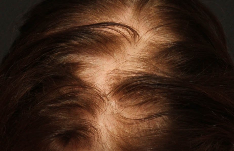 1_0001_Female_Before_1.jpg